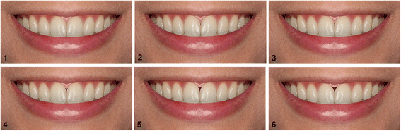 Comparison of Two Scales For Evaluation of Smile and Dental Attractiveness, PDF, Orthodontics
