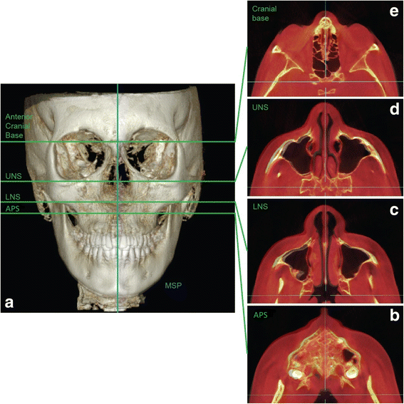 How Mewing Works - The Maxilla Sutures – Spartan Health™