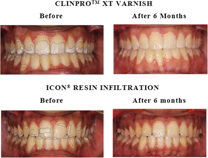 Comparative evaluation of Icon® resin infiltration and Clinpro™ XT varnish  on colour and fluorescence changes of white spot lesions: a randomized  controlled trial | Progress in Orthodontics | Full Text