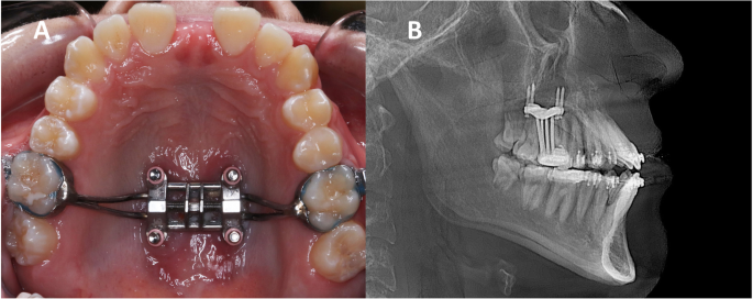 How Mewing Works - The Maxilla Sutures – Spartan Health™