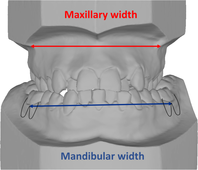 How Mewing Works - The Maxilla Sutures – Spartan Health™