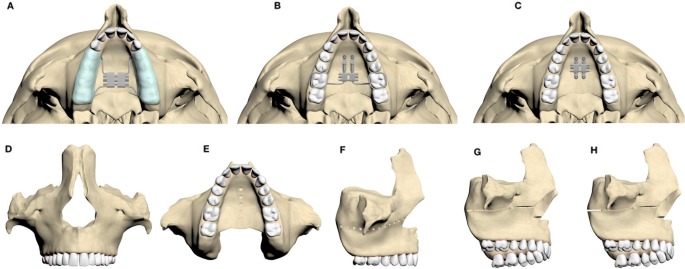 How Mewing Works - The Maxilla Sutures – Spartan Health™