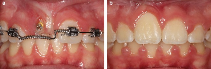 Comparison of dental anomalies between the groups with impacted