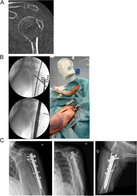 Mid-Shaft Humerus Fracture Treatment