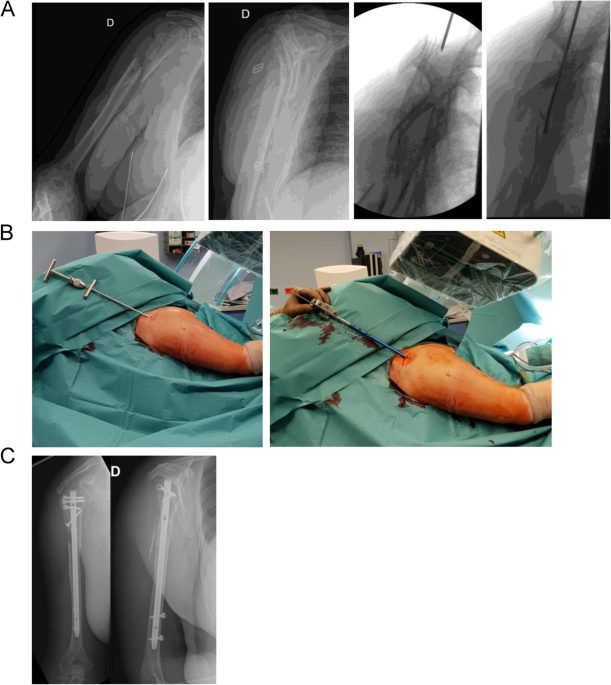 Locking intramedullary nails and locking plates in the treatment of  two-part proximal humeral surgical neck fractures: a prospective randomized  trial with a minimum of three years of follow-up. | Semantic Scholar