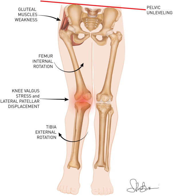 Sciences of Sport  Valgus knee: how effective are elastic mini-bands?