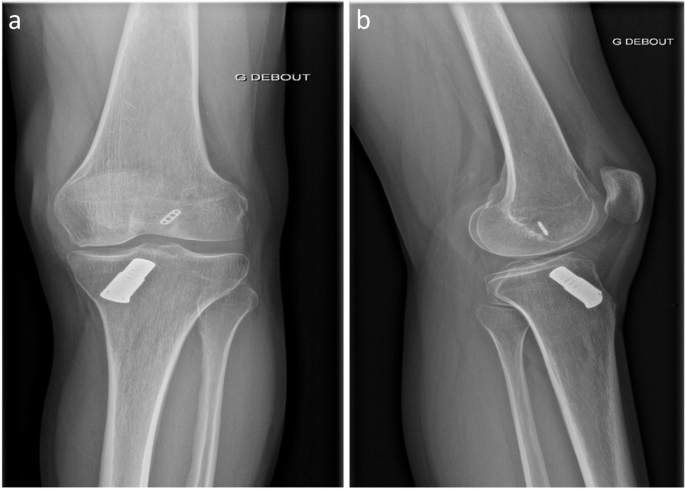 Arthroscopic picture of left knee revealing (a) bulky anterior cruciate