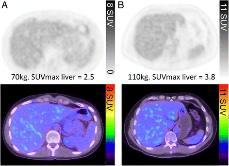 SUV comparison in 70kg vs 110kg patient