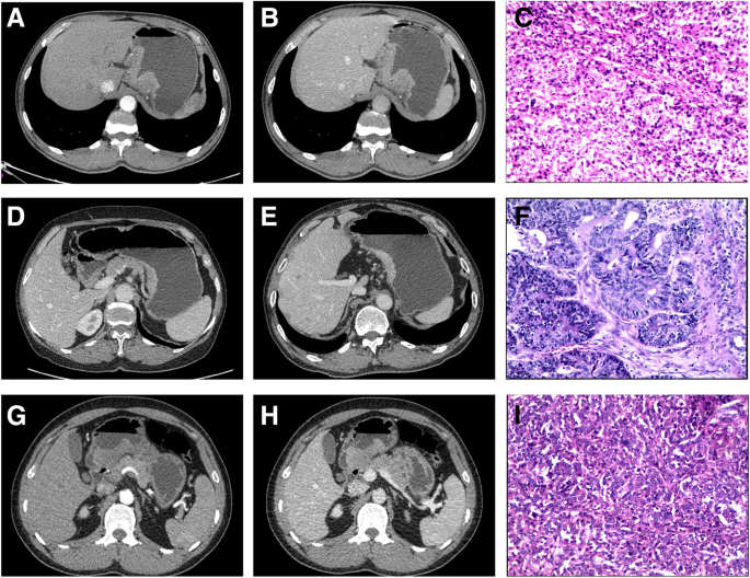 CT Scans & Cancer Detection