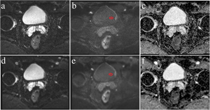 Comparison of SI with b value of 1000 s/mm2 in malignant and benign