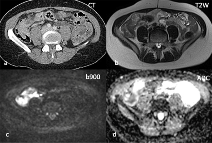 Representation of a breast undergoing expansion and subsequent