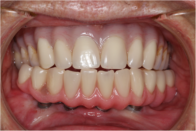 Calcium channel blocker induced gingival enlargement following implant  placement in a fibula free flap reconstruction of the mandible: a case  report | International Journal of Implant Dentistry | Full Text