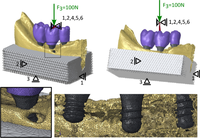 Biomechanical comparison of different prosthetic materials and posterior  implant angles in all-on-4 treatment concept by three-dimensional finite  element analysis