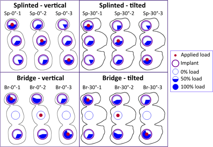 Biomechanical comparison of different prosthetic materials and posterior  implant angles in all-on-4 treatment concept by three-dimensional finite  element analysis