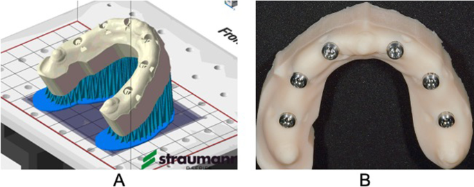 Can you use an intraoral scanner for upper jaw impressions