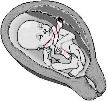 Nuchal cord and its implications | Maternal Health, Neonatology and  Perinatology | Full Text