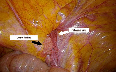 Laparoscopic repair of irreducible femoral hernia containing the fallopian  tube alone: a case report, Surgical Case Reports