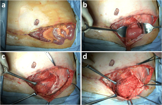 Spontaneous rupture of abdominal wall after breast reconstruction using  deep inferior epigastric perforator flap following mastectomy for breast  cancer, Surgical Case Reports