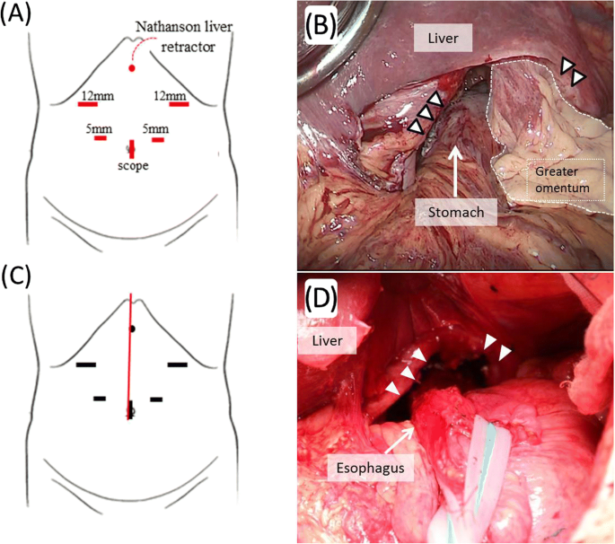 Hiatal Hernia Surgery: Recovery, Scars, and More