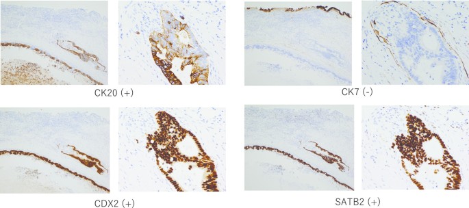 Ck7+ ck20+ tumors