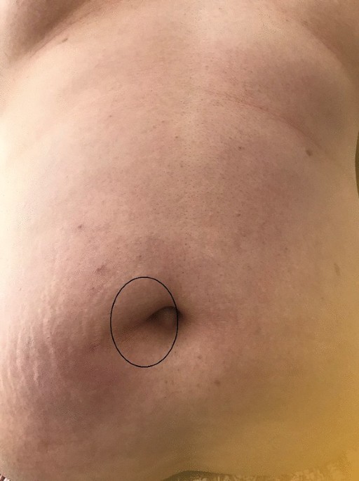 Needlescopic surgery for large umbilical hernia in a patient with morbid obesity using intraperitoneal onlay mesh with fascial defect closure: a case report | Surgical Case Reports