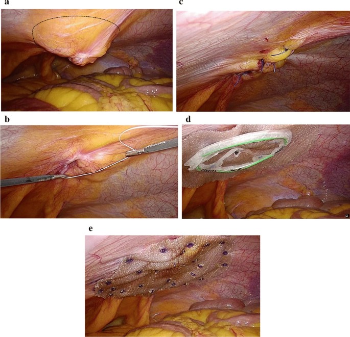A view from umbilical hernia accompanied by diastasis recti and mesh