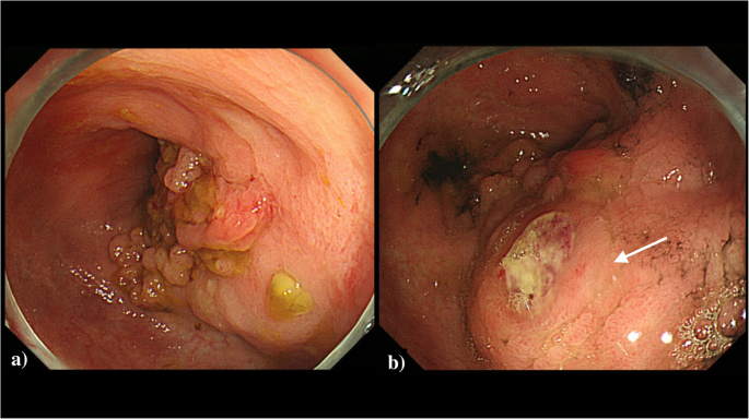 Colonoscopy of ulcerative colitis and bowel inflammation associated