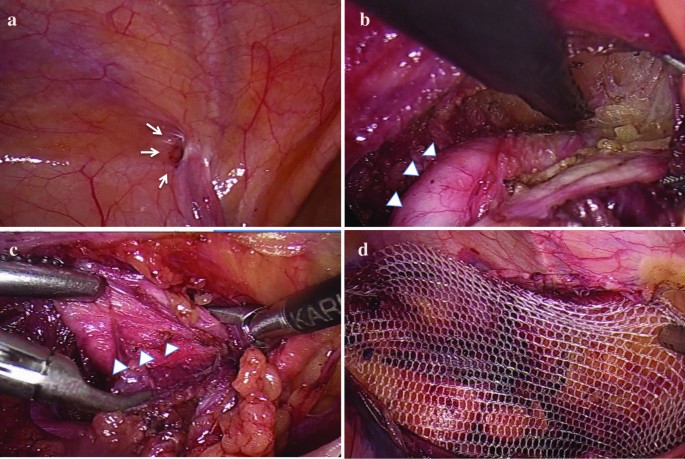 Laparoscopic surgical treatment for hydrocele of canal of Nuck: A case  report and literature review, Surgical Case Reports