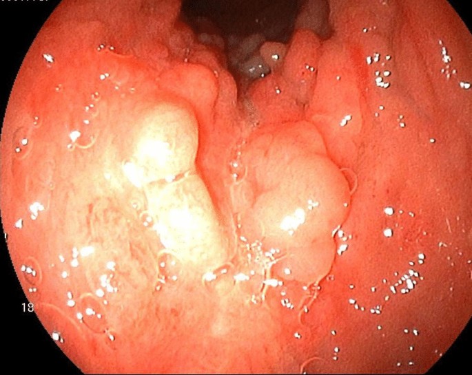 Colorectal cancer in Crohn's disease: a series of 6 cases | Surgical Case  Reports | Full Text