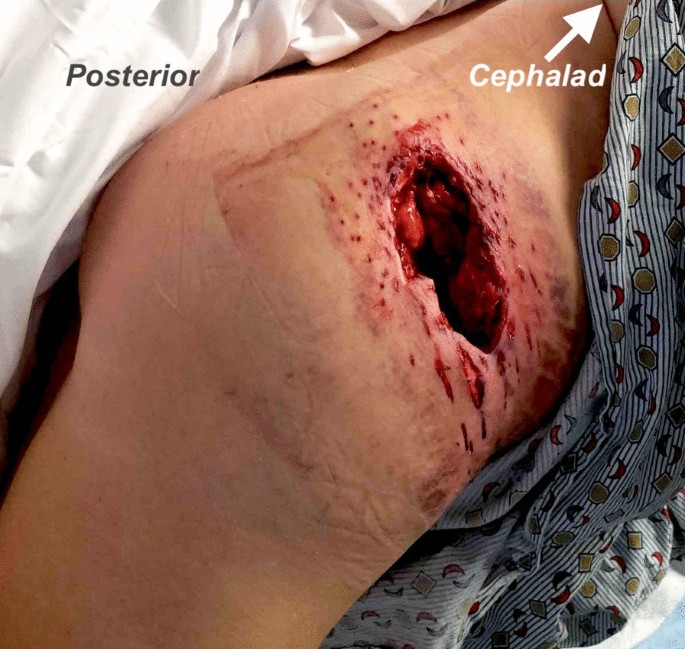A rare case of retained sabot after close-range shotgun injury | Surgical  Case Reports | Full Text