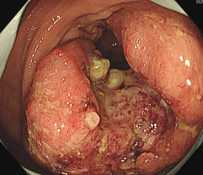 A rare case of sigmoid colon cancer in which the lower limbs received  collateral blood flow from the inferior mesenteric artery owing to  peripheral artery disease | Surgical Case Reports | Full Text