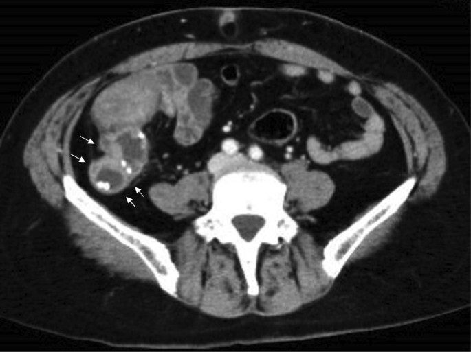Nonneoplastic signet-ring cell change in gastrointestinal and biliary  tracts: a pitfall for overdiagnosis. | Semantic Scholar
