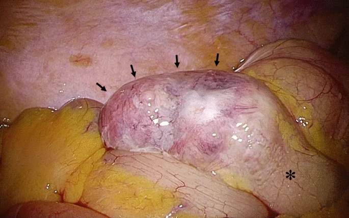 Signet Ring Cell Carcinoma of the Duodenal Bulb With Metastases to the  Ovaries and the Colon: A Case Report | Henry | Journal of Medical Cases