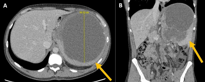 melanotic sarcoma liver Pathology Outlines Metastatic Malignant Melanoma