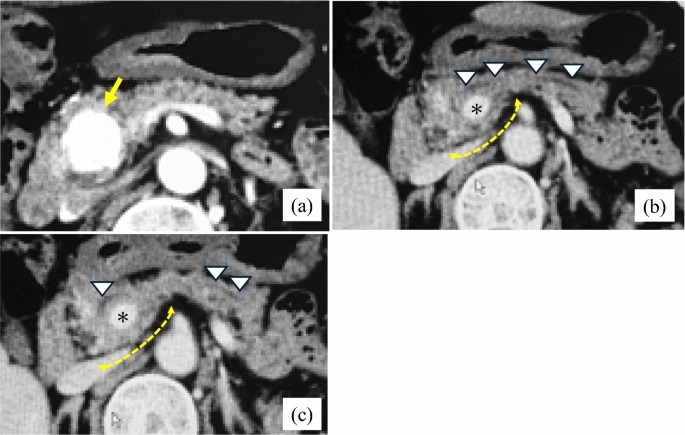 Minimally invasive pancreaticoduodenectomy for circumportal pancreas: literature review and report of two type IIIA cases