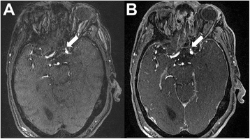 Imaging of cerebral aneurysms: a clinical perspective | Neurovascular  Imaging | Full Text
