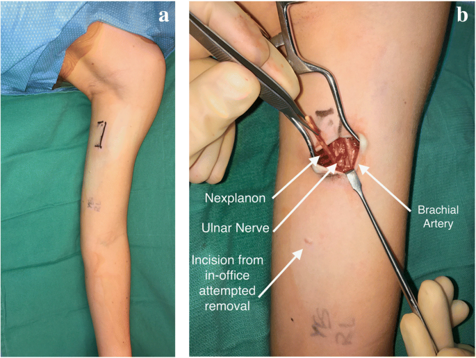 Peripheral nerve injury with Nexplanon removal: case report and review of  the literature | Contraception and Reproductive Medicine | Full Text