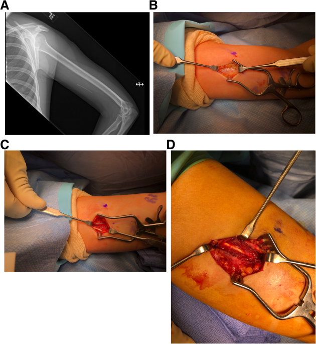 Subfascial‐located contraceptive devices requiring surgical removal, Contraception and Reproductive Medicine