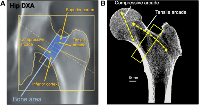 What's your t-score? Bone density scans for osteoporosis - Harvard Health