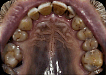 Hyperpigmentation of the hard palate mucosa in a patient with chronic  myeloid leukaemia taking imatinib | Maxillofacial Plastic and  Reconstructive Surgery