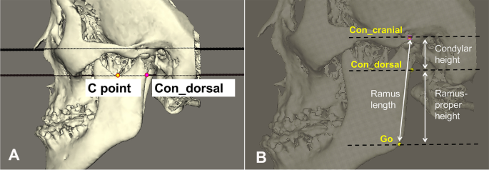 Prevalence of medial depression of the mandibu- lar ramus (MDMR) in the