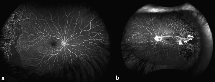 Ultra-wide-field fundus photographs and ultra-wide-field
