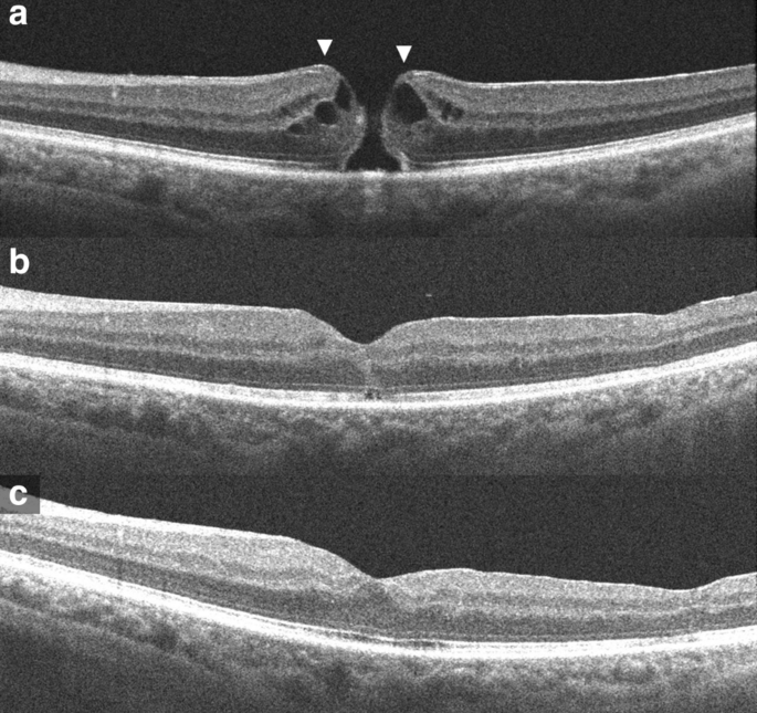Lamellar macular holes: evolving concepts and propensity for progression to  full thickness macular hole | International Journal of Retina and Vitreous  | Full Text