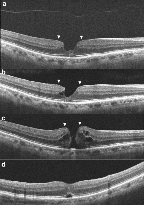 Lamellar macular holes: evolving concepts and propensity for progression to  full thickness macular hole | International Journal of Retina and Vitreous  | Full Text