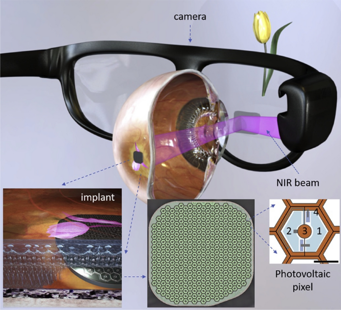 Wireless floating microelectrode array (WFMA) device before