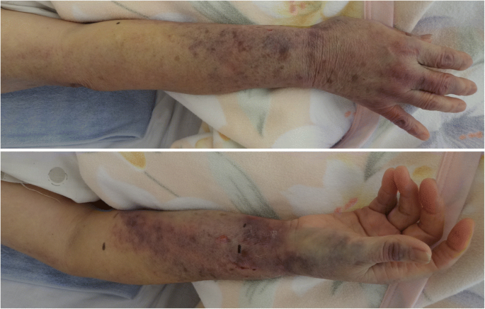 Delayed re-bleeding after removal of a radial arterial cannula | JA  Clinical Reports | Full Text
