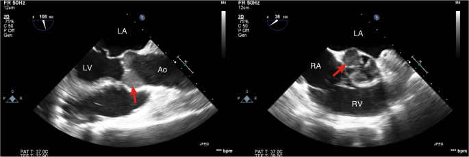 Predictors of Device-Related Thrombus Following Percutaneous Left