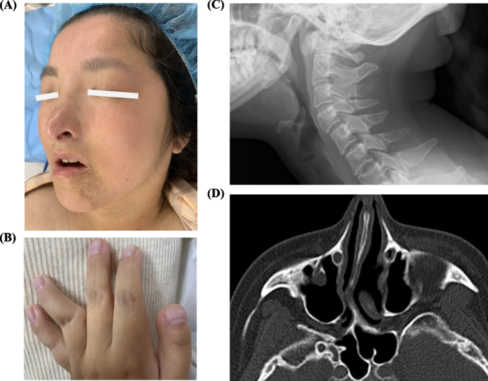 Anaesthesia Management in a Child with Rubinstein - Taybi Syndrome