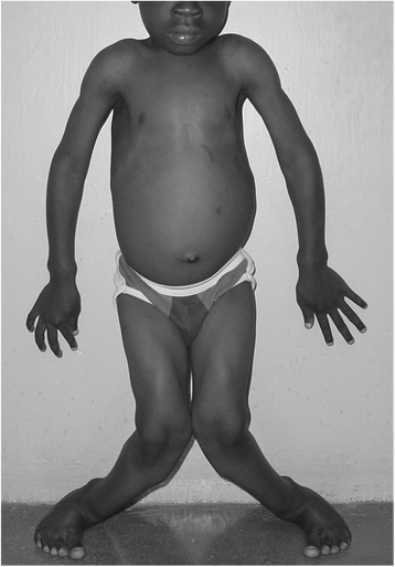 Nutritional rickets in immigrant and refugee children | Public Health  Reviews | Full Text