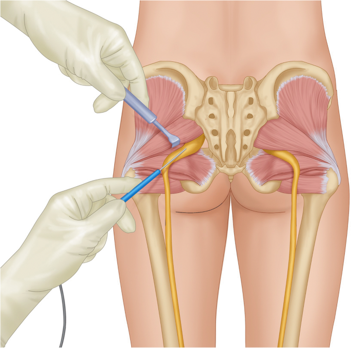 A minimally invasive surgical approach for the treatment of